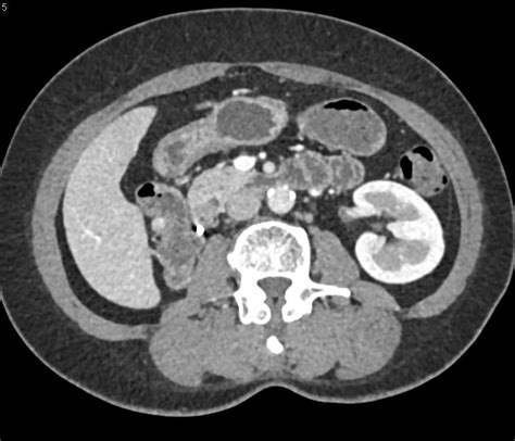 Cm Vascular Metastases Near Right Renal Bed In Patient With Renal Cell