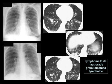 Ppt Le Syst Me Lymphatique Du Parenchyme Pulmonaire Et Sa Pathologie