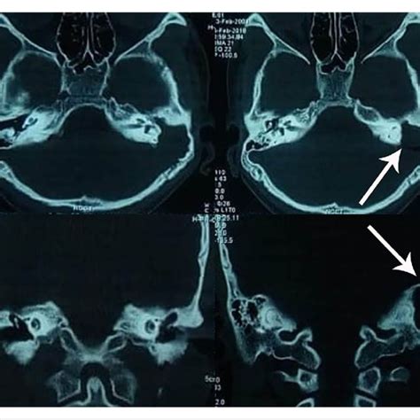 Retroauricular abscess in one of the cases. | Download Scientific Diagram