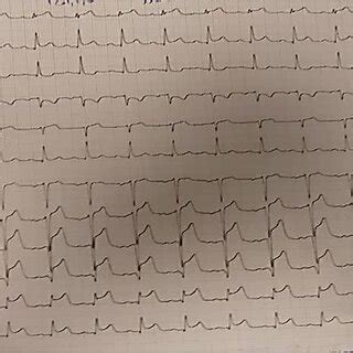 Electrocardiogram showing diffused ST‐segment elevation, and increased ...