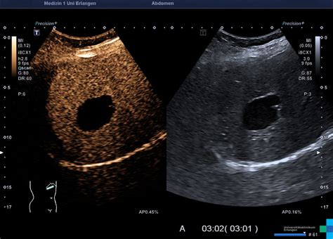 Liver Cyst Ultrasound