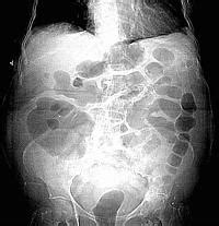 Ileus - wikidoc