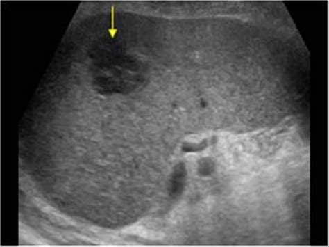 Wk 5 Spleen Pathology Malignant Lymphoma With A Vascularized Hypoechoic