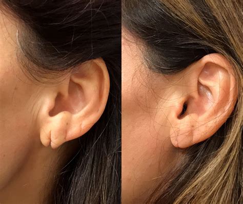 Before After Photos Earlobe Repair Nyc