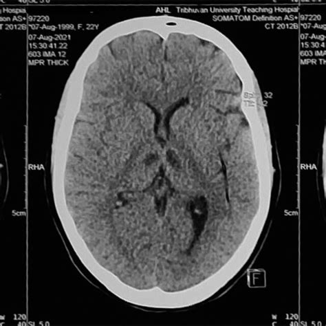 Noncontrast CT Scan Of Head Showing Bilateral Thalamic Hypodensity