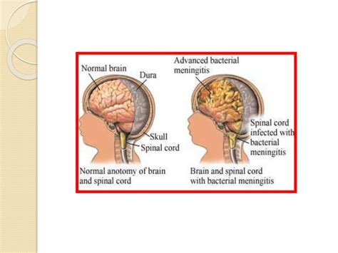 Meningitis (Pediatrics Lecture) | PPT