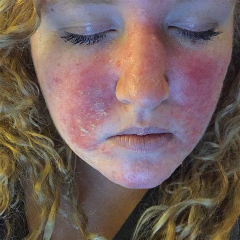 Allergic Reaction To Makeup On Face Mugeek Vidalondon