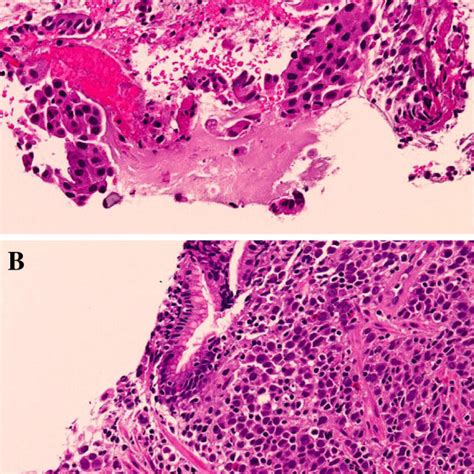 Gastric Lesion Observed By Gastroscopy Before And After Treatment With Download Scientific