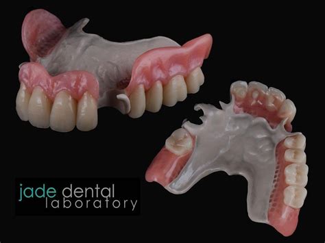 Partial Flexible Dentures | All Smiles Denture Clinic