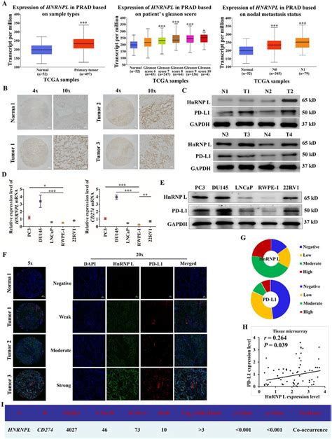 Hnrnp L And Pd L Are Co Expressed In Pca Cells And Pca Tumors A The