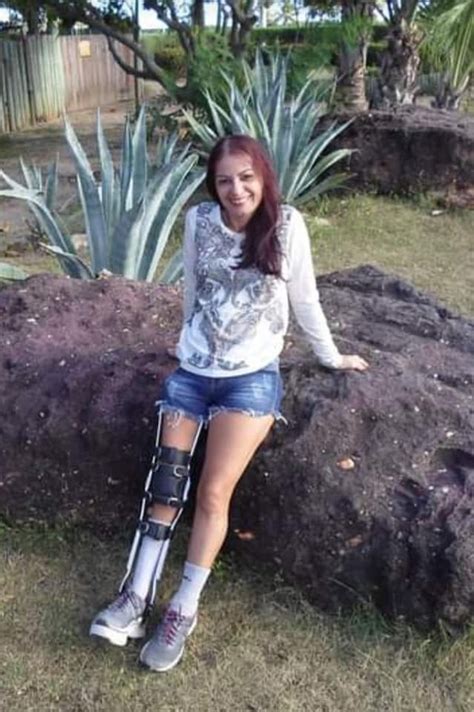 Amputee Leg Brace