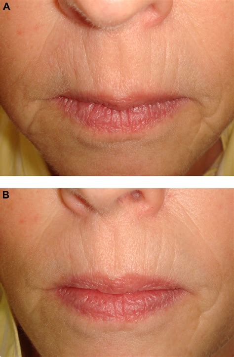 Figure 2 From Clinical Interventions In Aging Dovepress Perioral