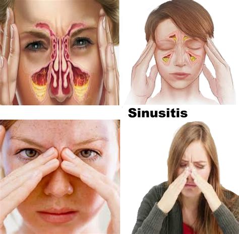 Sinusitis: Types, Symptoms, Test, Prevention, and Treatment.