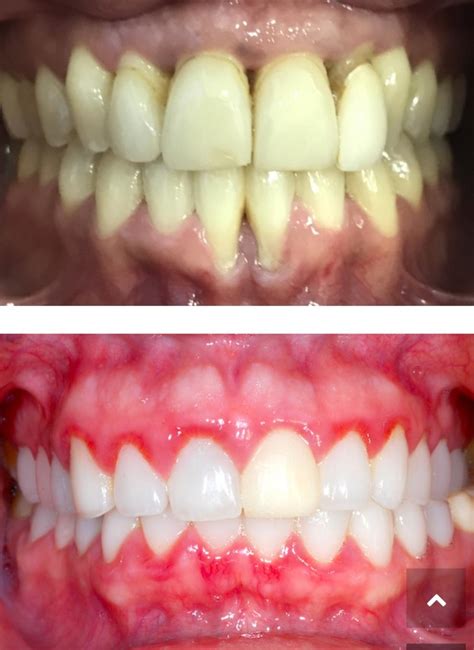 Paradentosis Periodontitis La Enfermedad De Los Tejidos De Sostén