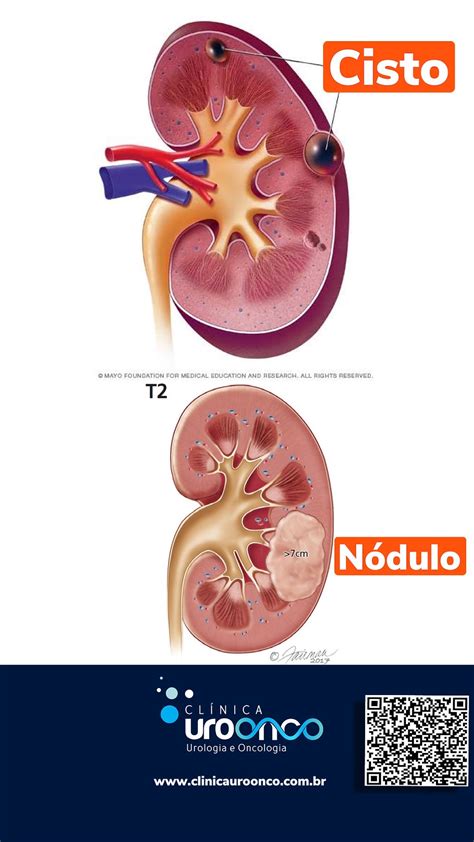 Cisto Renal O que é Causas Sintomas e Tratamentos Cura Natural