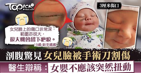 【醫療事故】剖腹產驚見女兒臉被刀割傷破相 醫生辯稱：女嬰不應該亂動 香港經濟日報 Topick 親子 兒童健康 D200926