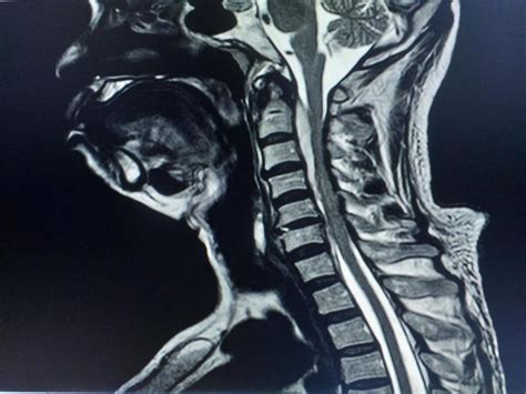 MRI Cervical-spine Shows C4-C5 Moderate spinal cord compression ...