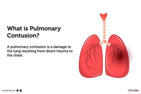 Pulmonary Contusion: Causes, Symptoms, Treatment and Cost