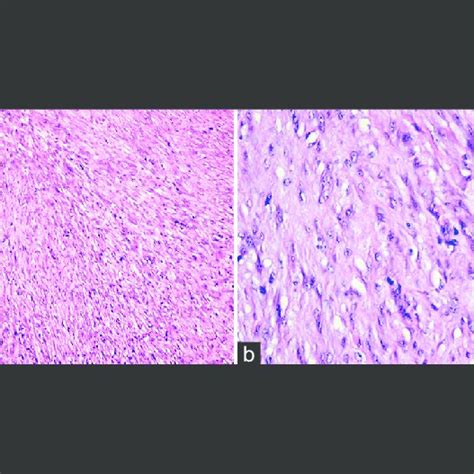 A Low Power View Showing Spindle Cells In A Background Of