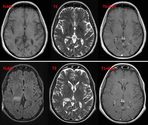 Ms Brain Lesions Vs Normal