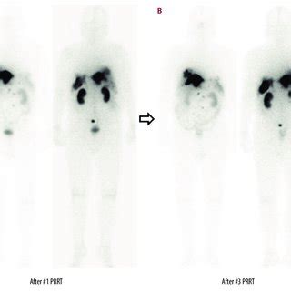 A B Anterior Posterior Whole Body Scan Findings After The First And