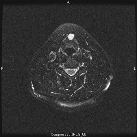 mri procedures and pathology: SOFT TISSUE NECK IN MR