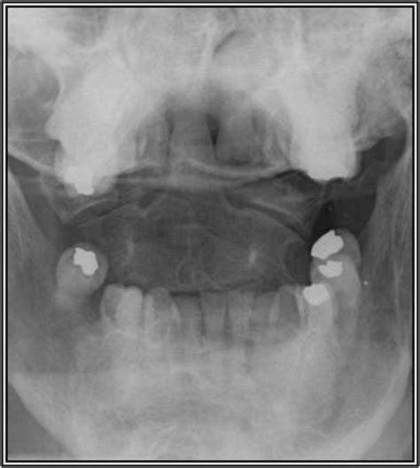 Image 37 39 Open Mouth Peg View Lateral Cervical Radiograph And An