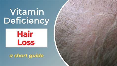 Vitamin Deficiency Causes Hair Loss A Guide Eating Enlightenment