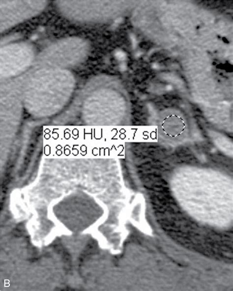 Adrenal Gland Enlargement And Nodules Radiology Key