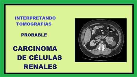 Probable Carcinoma De C Lulas Renales Interpretando Tomograf As Youtube