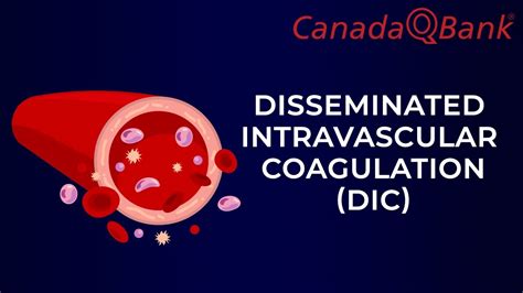 DIC Disseminated Intravascular Coagulation YouTube