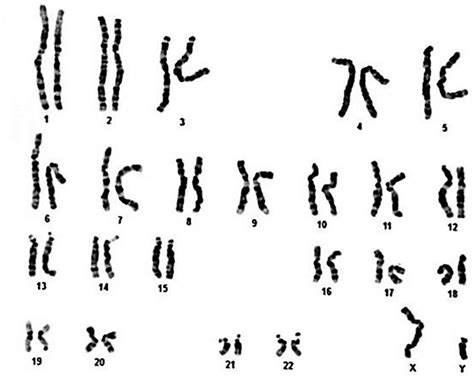 Chromosome Karyotype Of A Patient With Meier Gorlin Syndrome Orc