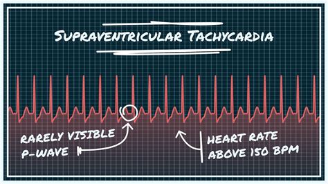 Svt Supraventricular Tachycardia Arrhythmias Causes Symptoms