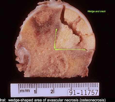 S M Msk Path Fractures Osteonecrosis And Osteomyelitis Flashcards