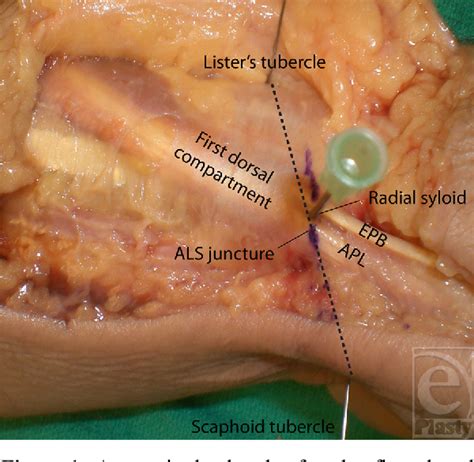 Pdf Anatomic Landmarks For The First Dorsal Compartment Semantic