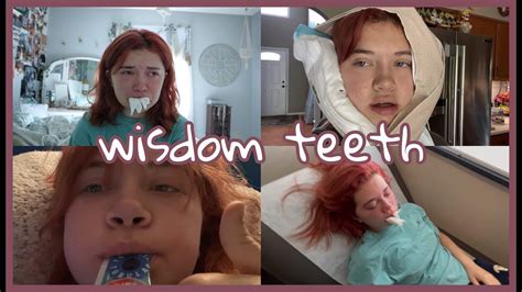 I Got My Wisdom Teeth Out Youtube