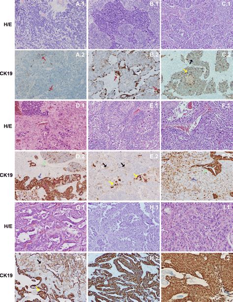 Haematoxylin Eosin And Krt Expression In Lung Primary Tumours A