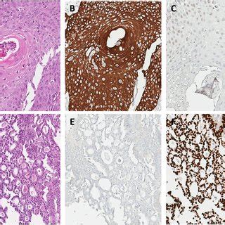 Typical Histologic Phenotype And Immunohistochemistry Staining Status