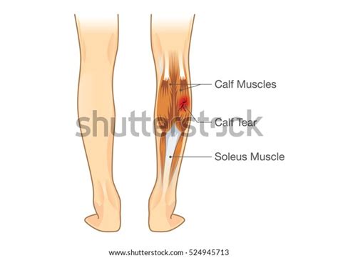 Calf Muscle Tear Illustration About Leg Stock Vector (Royalty Free) 524945713