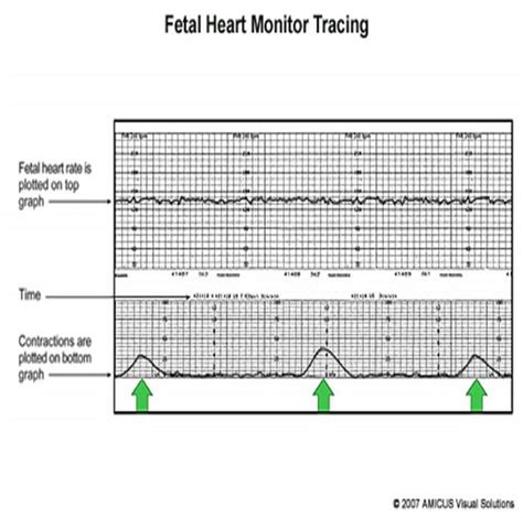 Fetal Heart Monitoring Flashcards Quizlet