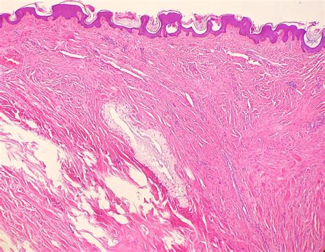 [figure Corticosteroid Keloid Contributed By Dylan Maldonado Md