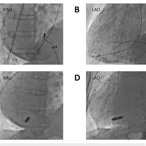 The Implantation Of The Leadless Pacemaker A Right Ventriculography In