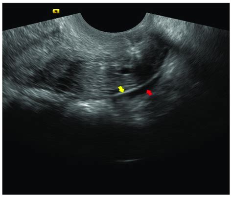 In The Sagittal Plane The Stretched Normal Uterosacral Ligament