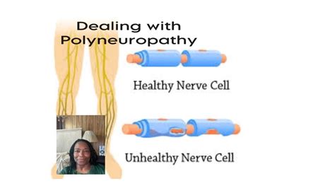 Peripheral Polyneuropathy: Part 2 #depression #chronicillness # ...