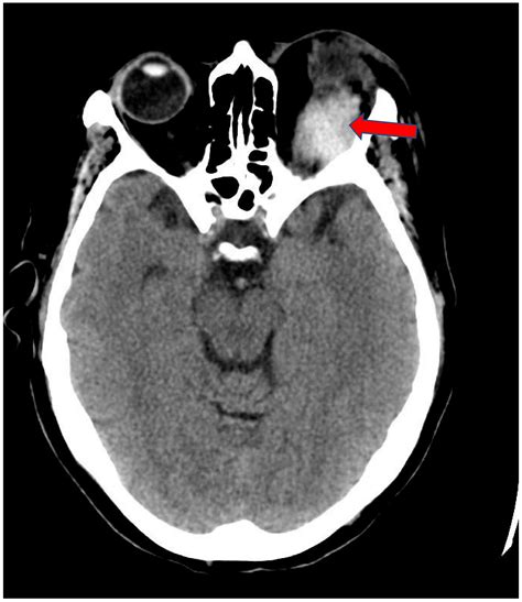 Retrobulbar Hematoma