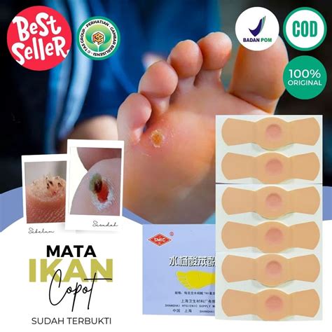 Jual Plaster Mata Ikan Obat Kapalan Kutil Dan Mata Ikan Di Kaki Tangan