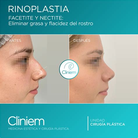 Rinoplastia Fotos Cliniem