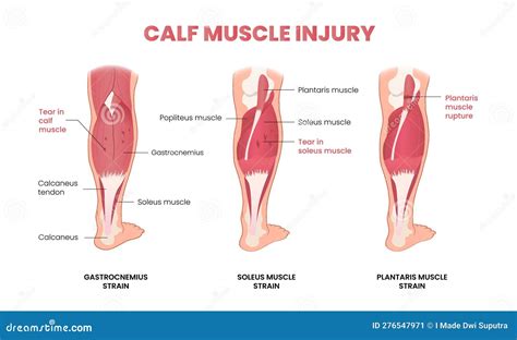 Calf Muscle Injury Infographic Stock Vector Illustration Of Plantaris