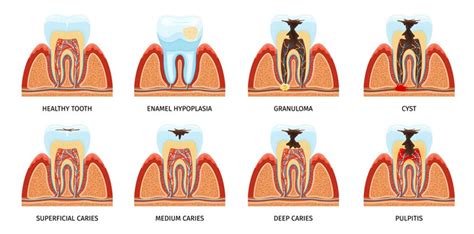 Tooth Extractions Creadent Multispeciality Dental Clinic