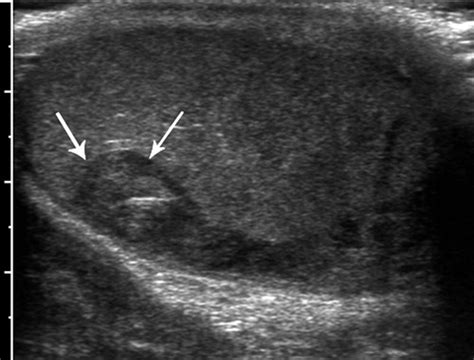 Testicular Rupture Ultrasound